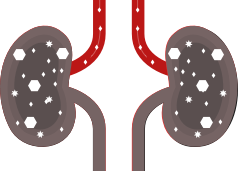 Illustration of later stages of chronic kidney disease