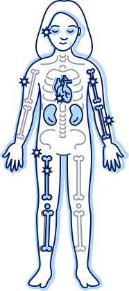 Female skeleton with calcium oxalate crystals highlighted
