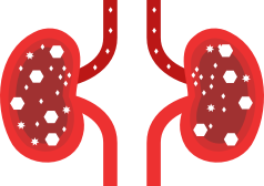 Illustration of crystal formation and stones in the kidneys
