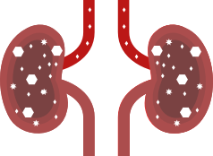 Illustration of chronic kidney disease